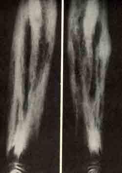 Рентгеновские снимки костей голени и предплечья