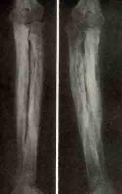 Рентгеновские снимки костей голени и предплечья