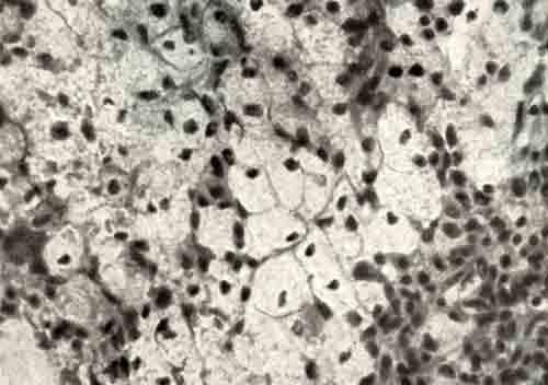 Пенистые клетки и ксантомные клетки