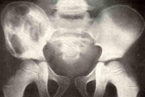 Костный эозинофилез, рентгенограмма таза