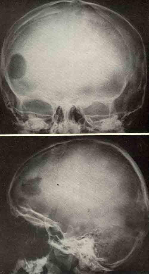 Поражение костей свода черепа при костном эозинофилезе