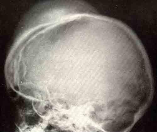 Остеома черепа у ребенка с деформирующей суставной хондродисплазией