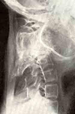 Рентгенограммы остеобластокластомы