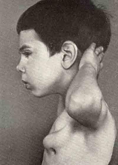 Хондрома грудной клетки у мальчика 7 лет, развившаяся из экзостоза
