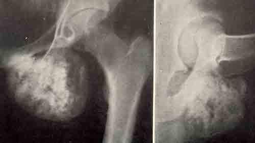 Экхондрома левой седалищной кости у девочки 10 лет