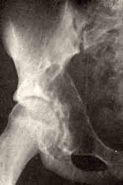 Кистозная форма остеобластокластомы