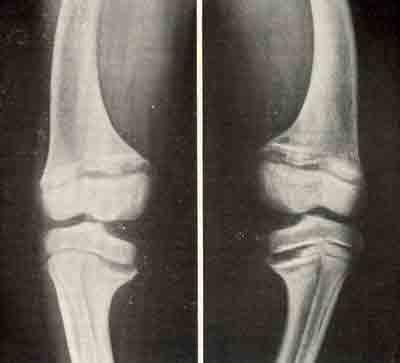Рентгенограмма коленных суставов больного с ренальным рахитом