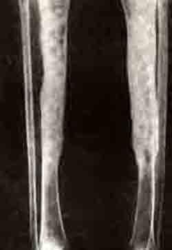 Бластоматозный ретикулез кости
