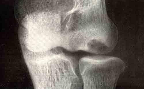Редкая форма остеохондропатии головчатого возвышения плечевой кости