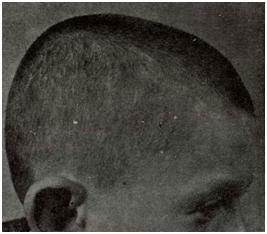 Pityriasis versicolor на волосистой части головы у мальчика 11 лет