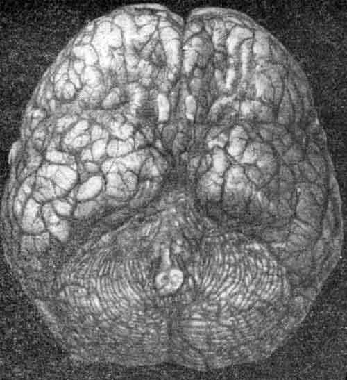 Мозг больного П-ва, 10 лет