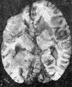 Обширное размягчение в лобных и височной доле мозга