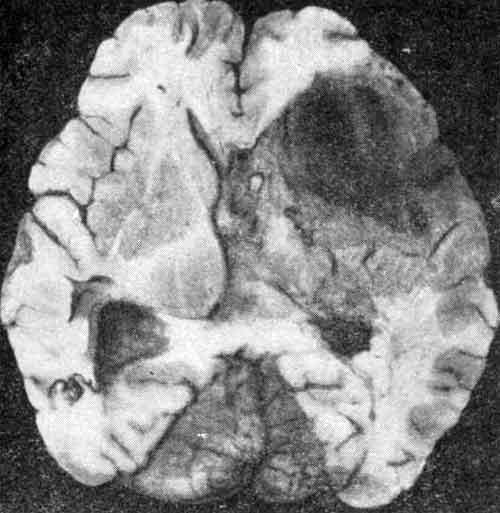 Кровоизлияние в левую лобно-теменную область