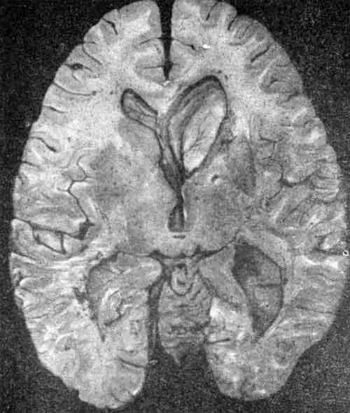 Выраженная гидроцефалия III и боковых желудочков
