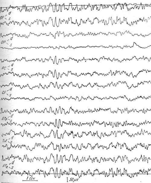 ЭЭГ больного Г., 5,5 лет