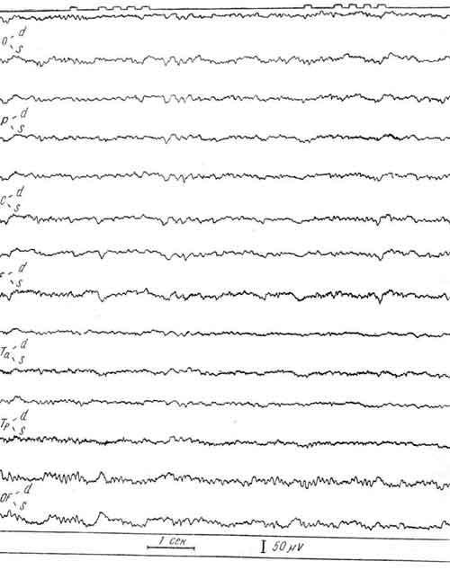 ЭЭГ больного В., 14 лет