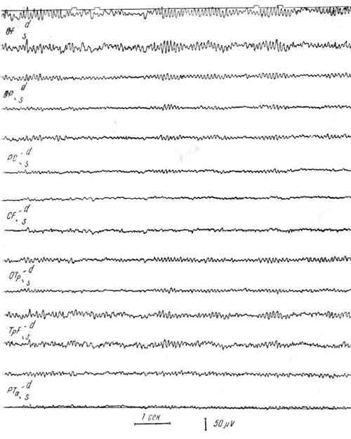 ЭЭГ больного С., 13 лет