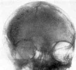 Рентгенограмма черепа и ЭЭГ больного А.