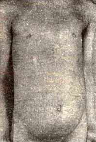 Ichthyosis vulgaris у девочки шести лет