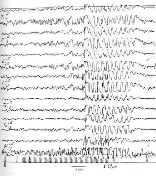 ЭЭГ больной