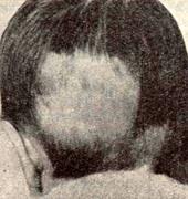 Alopecia areata у мальчика 1 года и 8 мес