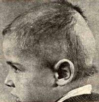 Alopecia arteficialis у мальчика пяти лет — стойкие изменения после облучения рентгеновыми лучами с лечебной целью