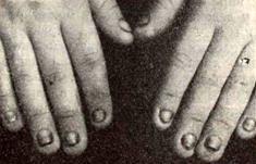 Brachyonychia (короткие ногти)