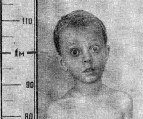 Мальчик 3 лет 8 месяцев с выраженным тиреотоксикозом