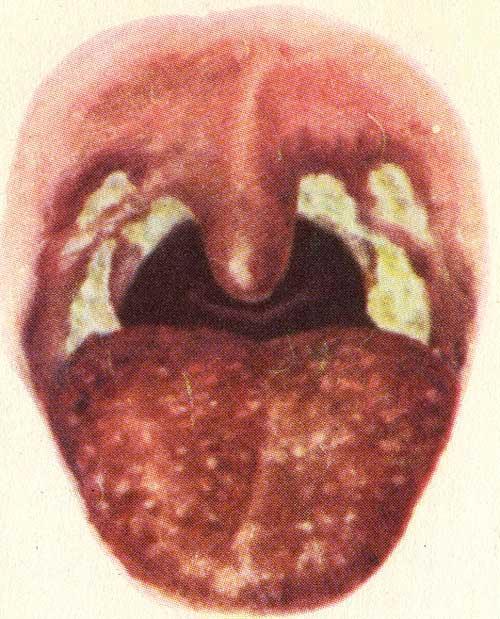 Скарлатина. Некротическая ангина
