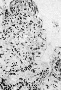 Кишечная инфекция вызываемая синегнойной палочкой (патогенез)