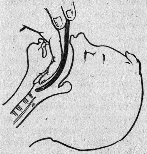 Интубация трахеи через рот «вслепую»