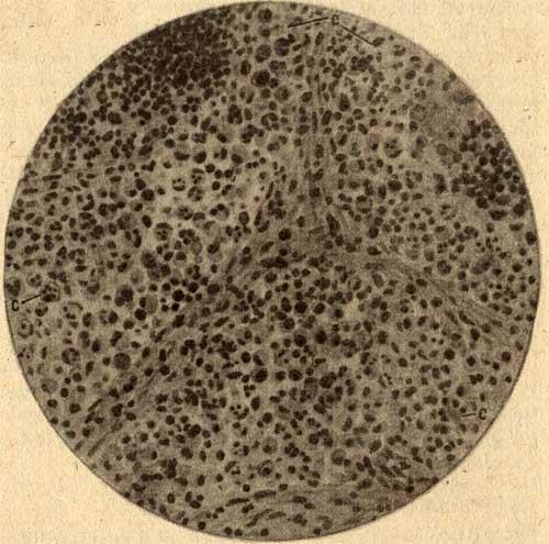 «Тифозные клетки» в лимфатическом узле брыжейки  при брюшном тифе (по И. В. Давыдовскому)