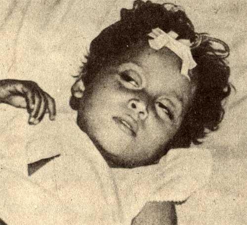 Вид ребенка, больного холерой (по О. В. Барояну)