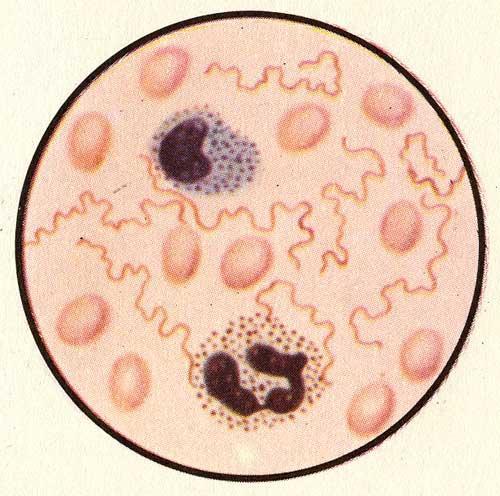 Спирохета Обермейера в крови (по Е. П. Шуваловой и  Т. Г. Старковой)