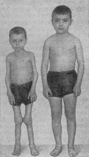 Отставание в физическом развитии при ревматоидном артрите (больной слева)