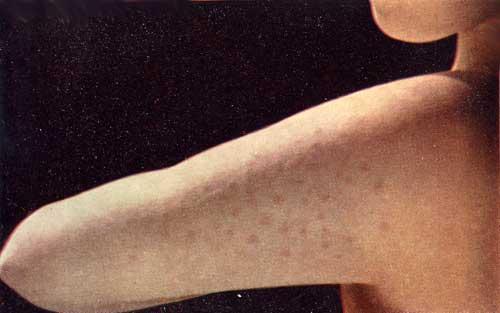 Аллергическая макуло-панулезная и уртикароподобная сыпь при ревматоидном артрите