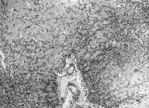 Отложение амилоида в ткани печени (X 90) Отложение амилоида в ткани печени (X 90)