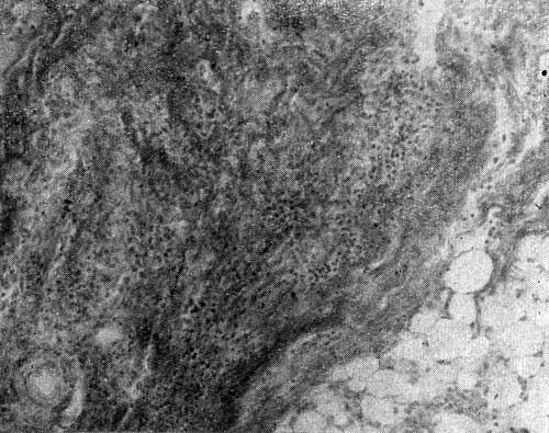 Лимфоидно-плазмоклеточная инфильтрация в склеротически измененном перикарде (X 135)