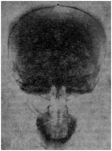 Рентгенограммы черепа детей с большой талассемией (череп «щетка»)
