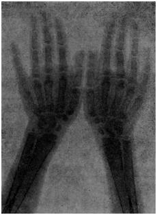 Рентгенограмма кистей рук больного А., 10 лет, с большой талассемией