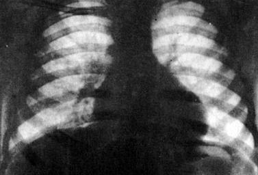 Рентгенограмма грудной клетки больной Г., 4 лет, с наследственной сфероцитарной гемолитической анемией