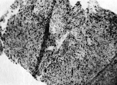 Вторичный гемохроматоз печени у больной с тяжелым течением сфероцитарной гемолитической анемии (ув. 90)