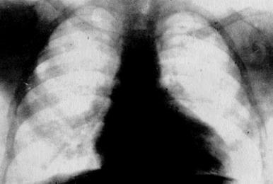 Рентгенограмма грудной клетки больного А., 10 лет, с большой талассемией