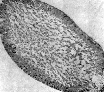 Электронно-микроскопическое строение эритроцита у больного с идиопатической аутоиммунной гемолитической анемией в период обострения (ув. 8000)