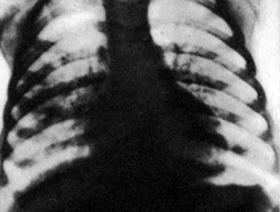 Рентгенограмма грудной клетки больного с идиопатическим гемосидерозом легких