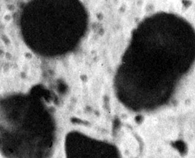 Макрогемоцитофаги в мокроте у больной с идиопатическим гемосидерозом легких (ув. 600)