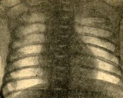 Рентгенограмма органов грудной клетки новорожденного ребенка (собственное наблюдение)