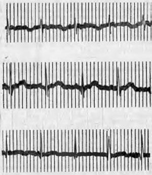 Электрокардиограмма новорожденного ребенка (собственное наблюдение)