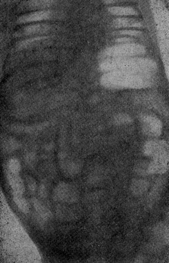 Рентгенограмма при непроходимости кишечника у новорожденного ребенка