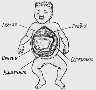 Расположение внутренних органов при эритробластозе (по Поттеру)